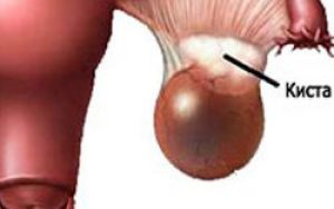 Эндометриоидная киста яичника операция