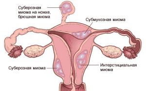 Маточные кровотечения при миоме