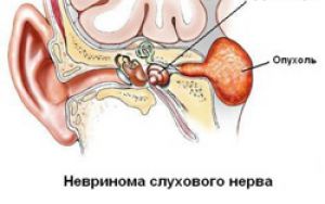 Невринома слухового нерва